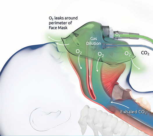 Nasal Cannulas